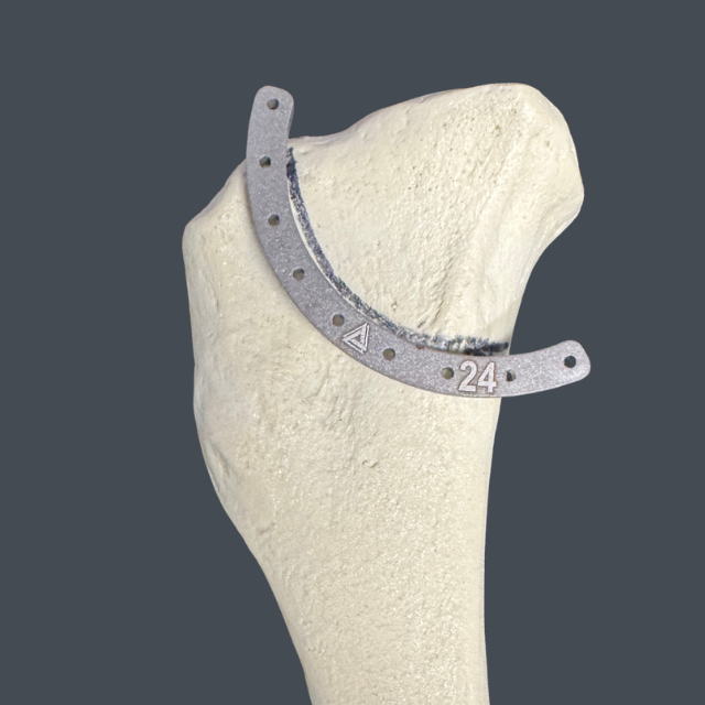 Model of a bone (likely a femur) with an external fixation ring device wrapped around it; a curved metal plate with holes and the number 24 is attached to the bone.