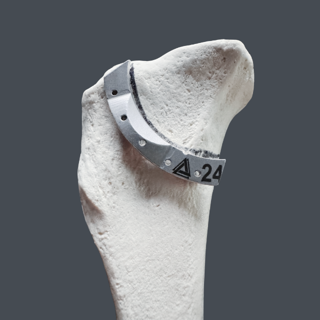 Close-up of a white bone with a metallic circular fixation plate wrapped around it, secured by screws or bolts, on a dark background.